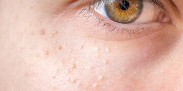 Jangan Dipencet ! Berikut 6 Tips Menghilangkan Milia Secara Aman