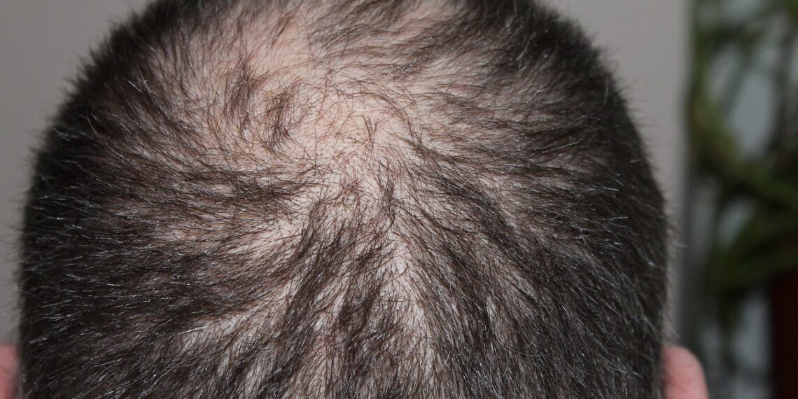 3 Vitamin yang dapat Menyembuhkan Kerontokan Rambut