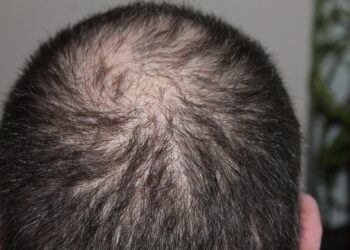 3 Vitamin yang dapat Menyembuhkan Kerontokan Rambut