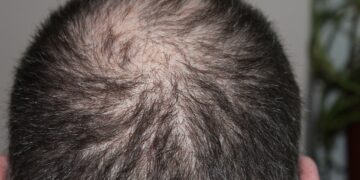3 Vitamin yang dapat Menyembuhkan Kerontokan Rambut
