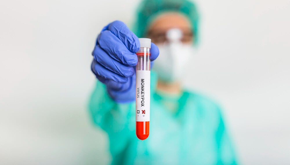 Waspada Cacar Monyet, Berikut Gejala dan Cara Pencegahannya